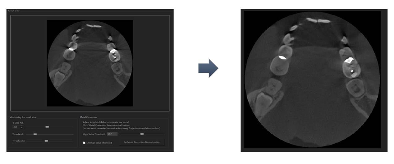 Before-and-after VXRE metal artifact reduction example